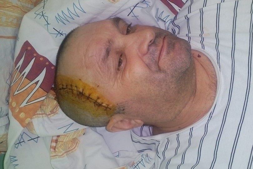 Лише трепанація змогла врятувати львів’янину життя (+ФОТО)