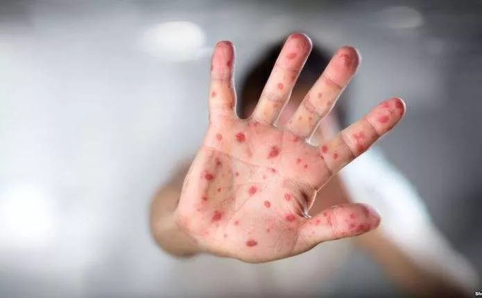 Найчастіше на кір хворіють на Львівщині, найменше на Рівненщині: статистика по Західній Україні